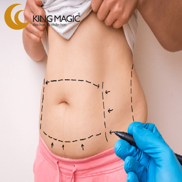 Phẫu thuật căng da bụng