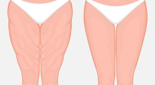phẫu thuật căng da đùi
