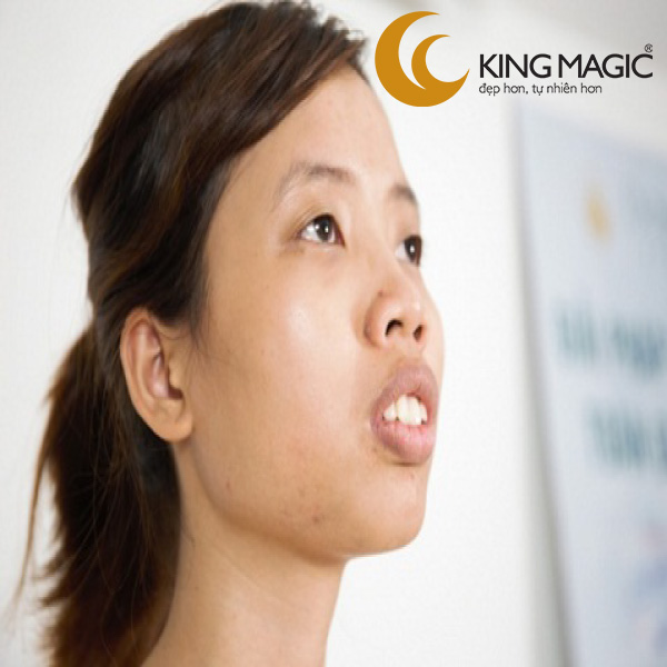 Phẫu thuật làm dài mũi