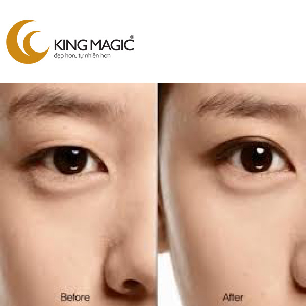 Phẫu thuật lấy da/mỡ mí trên